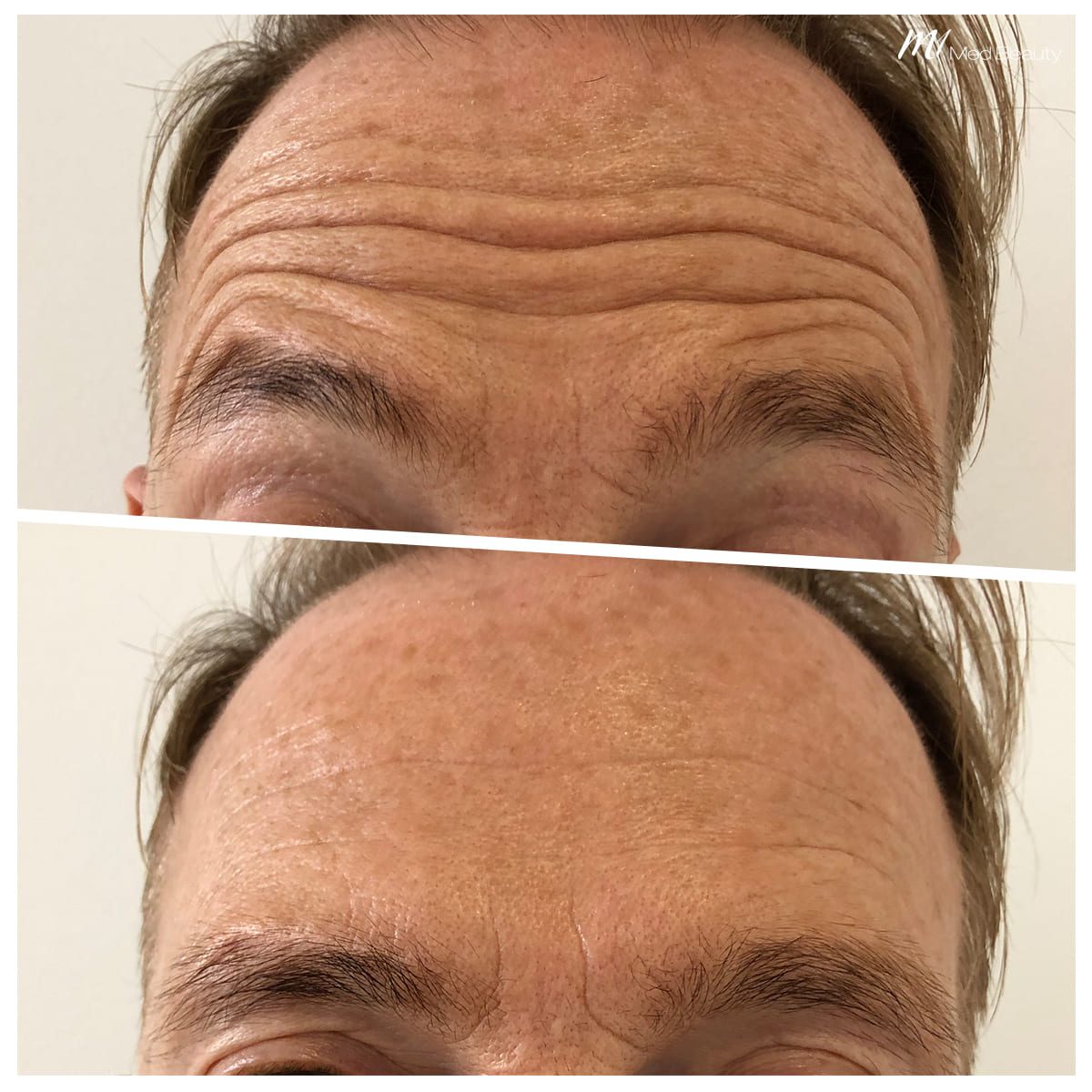 Forehead lines treatment