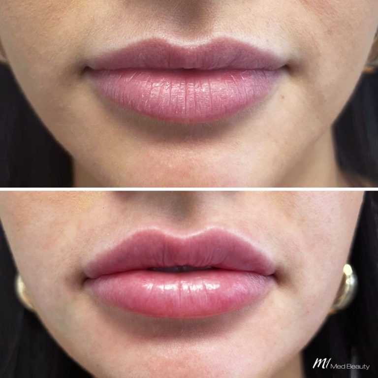 lip filler before after 11
