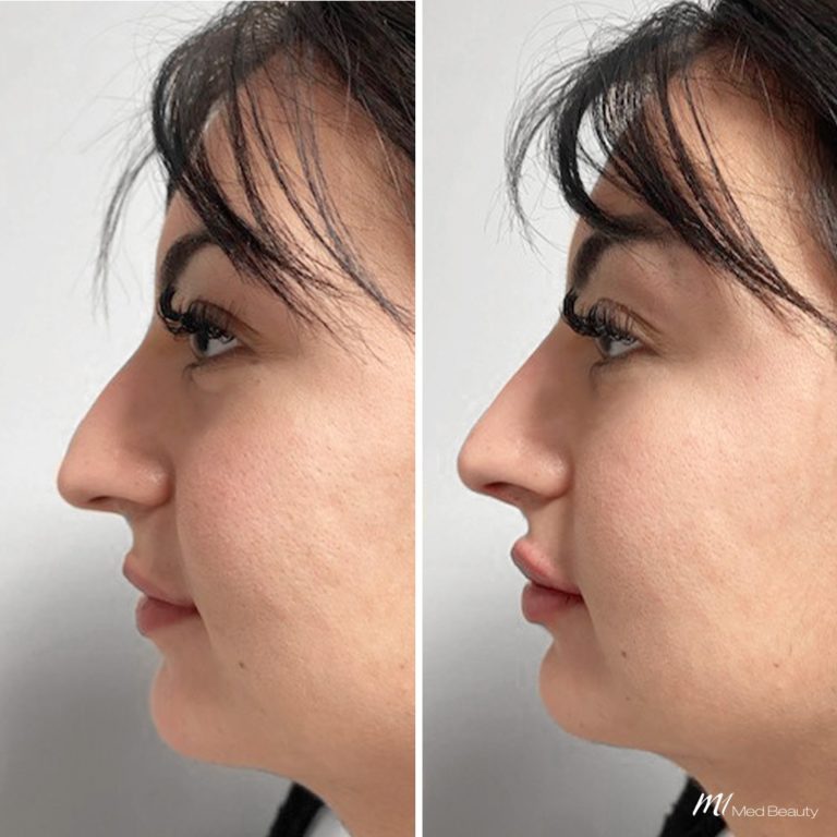 nose dermal filler before after 4