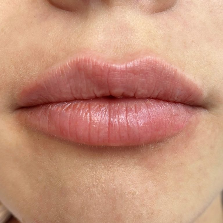 lip filler before after 9