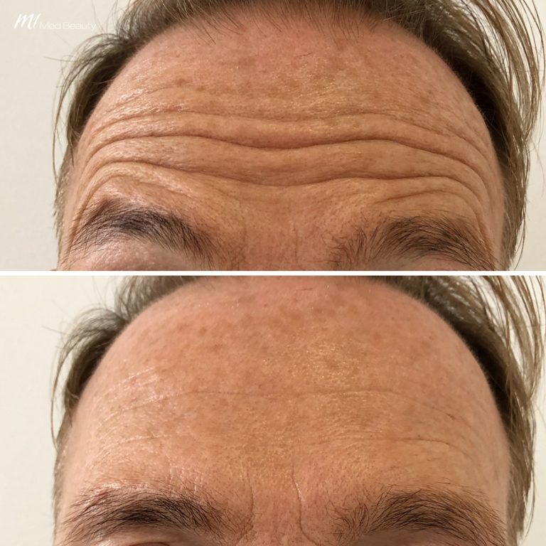 forehead lines anti wrinkle before after 4